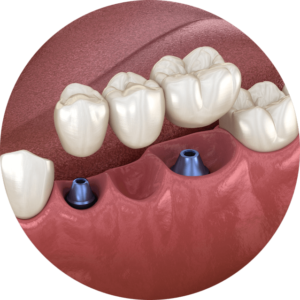 dental implant bridge model