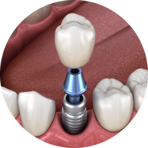 dental implant surgery model