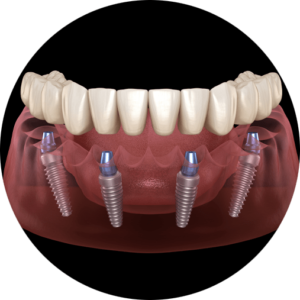 full arch dental implants