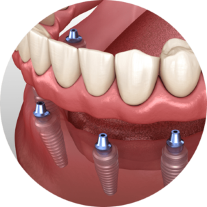 implant supported denture