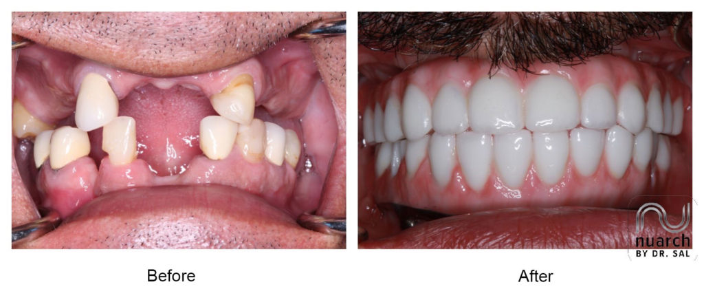 Before and after Dental Implants