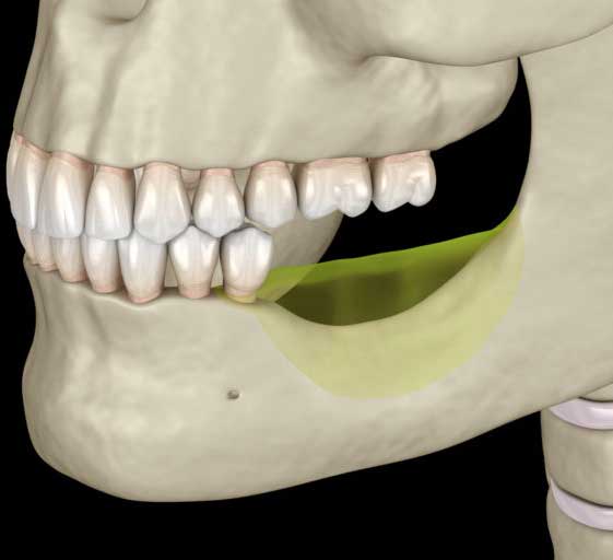 jaw bone loss