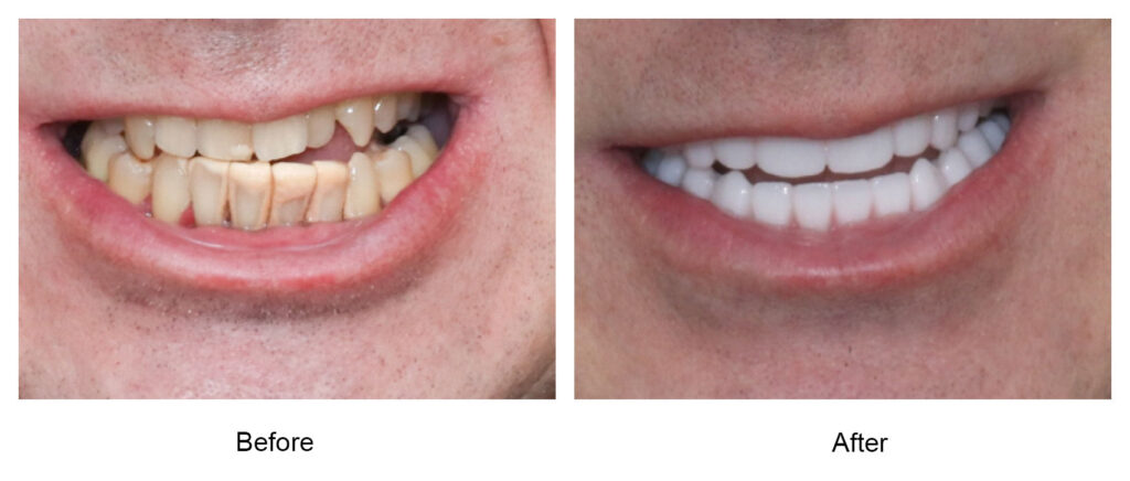 before and after dental implants