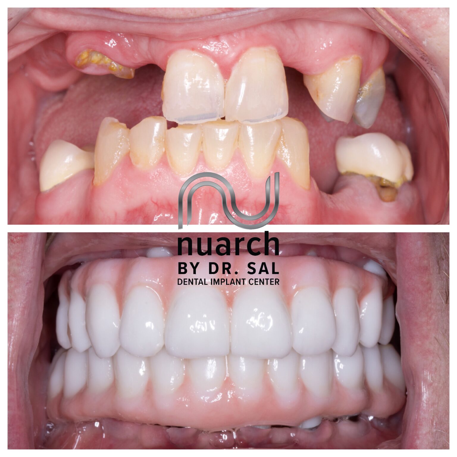 Full Mouth Dental Implant Before After Photos Dental Implant Center full-mouth-dental-implant-before-after-photos-dental-implant-center