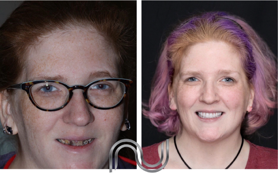 before and after dental implant Ashland