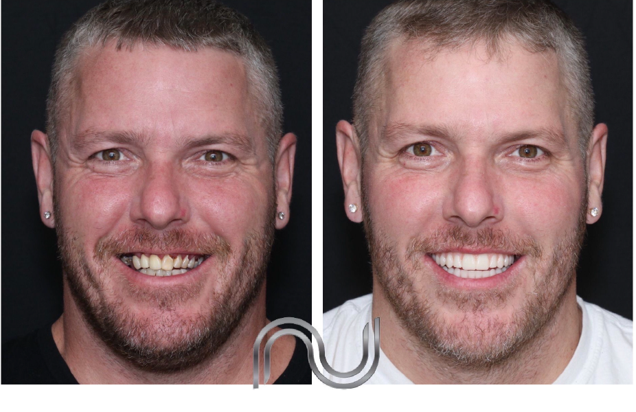 before and after dental implants